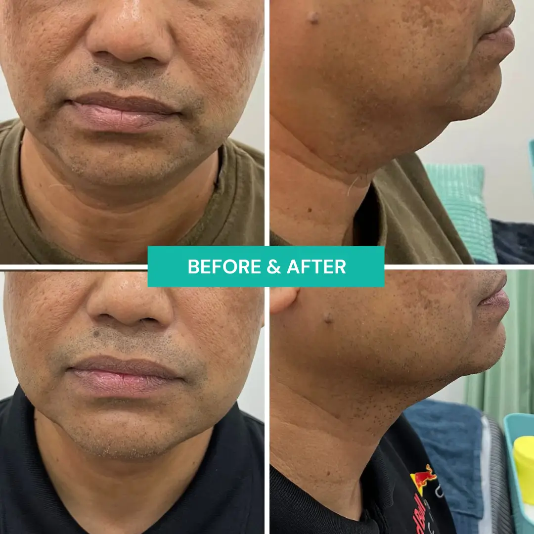 Before After Fat Melting